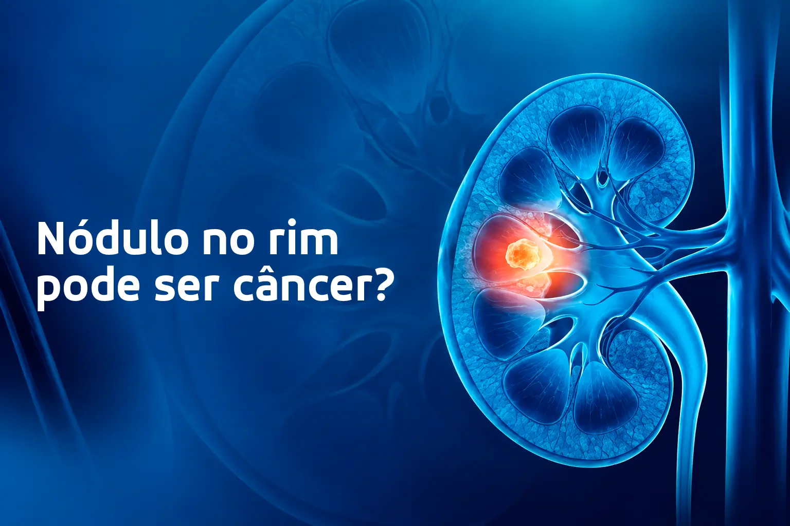 Ilustração de um rim com destaque para um nódulo renal.