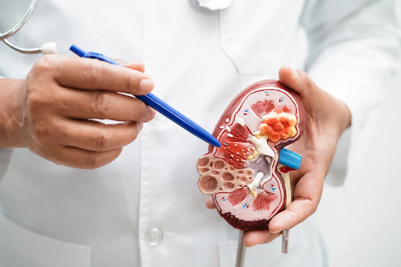 Avaliação de câncer de rim e nódulo renal